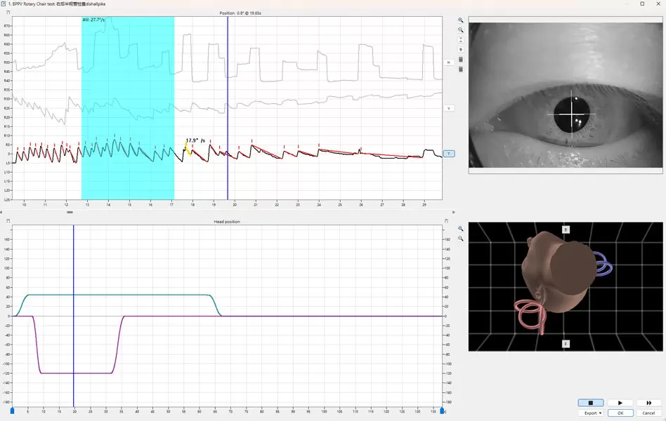 Revolutionary 3D Nystagmus Analysis